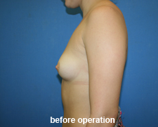 plastic-surgery-breast-augmentation